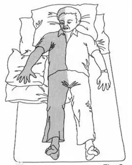 早期康復(fù)—良肢位的擺放